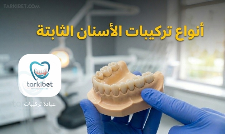 أنواع تركيبات الأسنان الثابتة