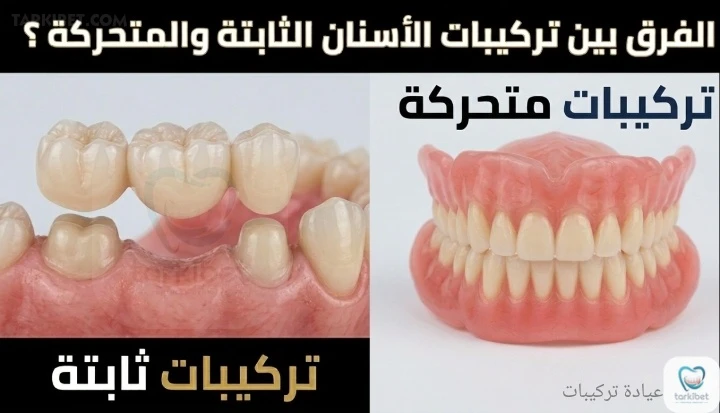 الفرق بين تركيبات الأسنان الثابتة والمتحركة و أيهما الأفضل لك