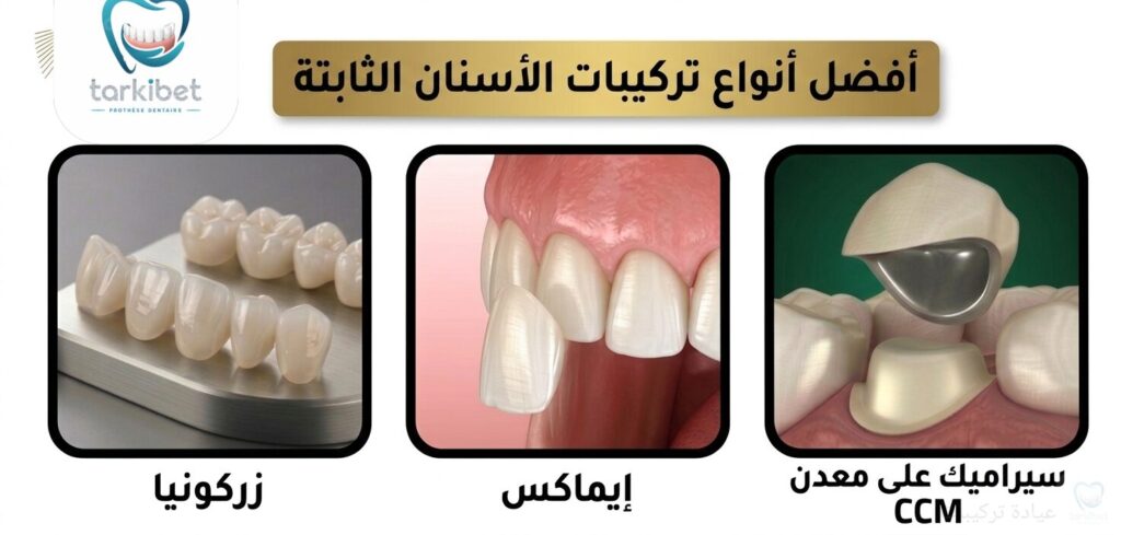 أفضل أنواع تركيبات الأسنان الثابتة