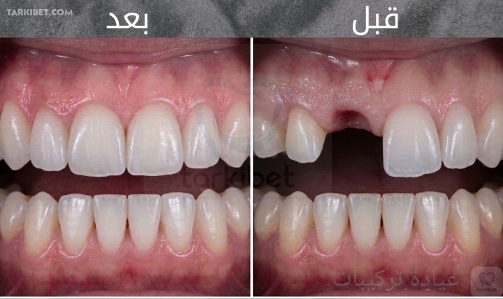 حالة تركيب اسنان emax قبل و بعد