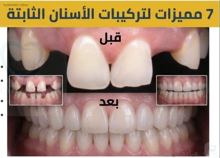 مميزات تركيبات الأسنان الثابتة