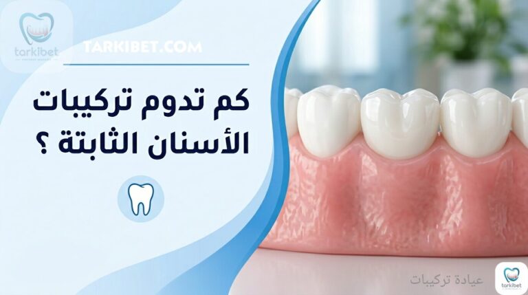 كم تدوم تركيبات الأسنان الثابتة ؟