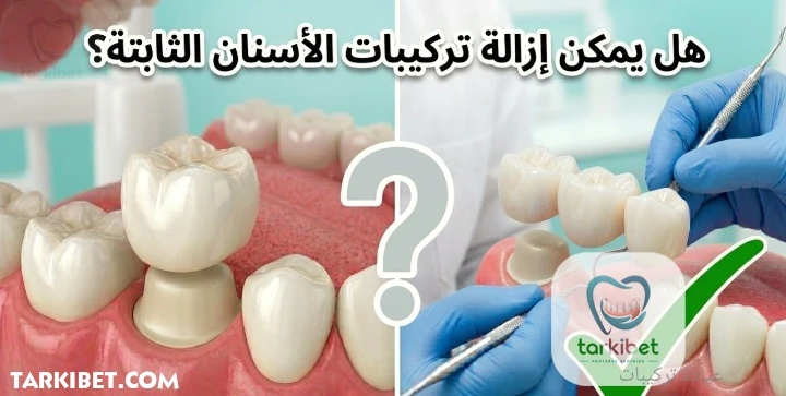 هل يمكن إزالة تركيبات الأسنان الثابتة ؟