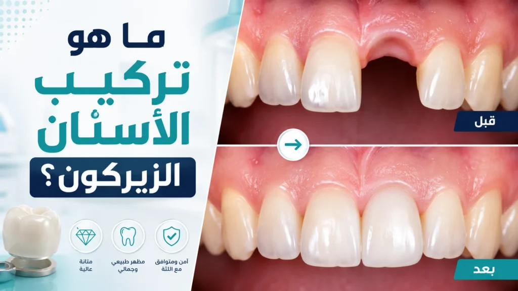 ما هو تركيب الأسنان الزيركون
